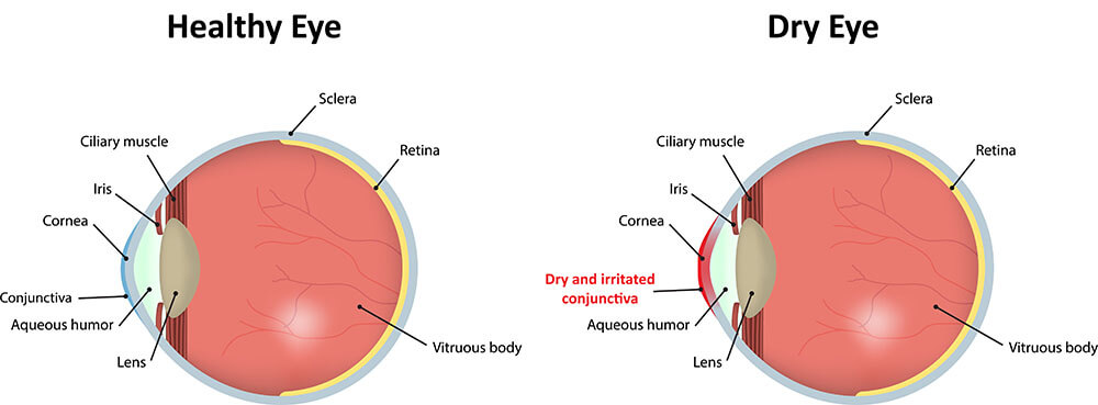 Chart Illustrating a Healthy Eye Compared to One Experiencing Dry Eye