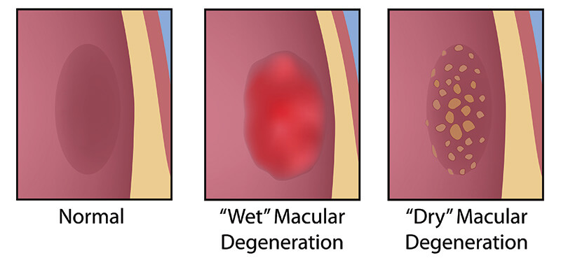 Chart Illustrating a Normal Eye Compared to One With Wet and Dry Macular Degeneration