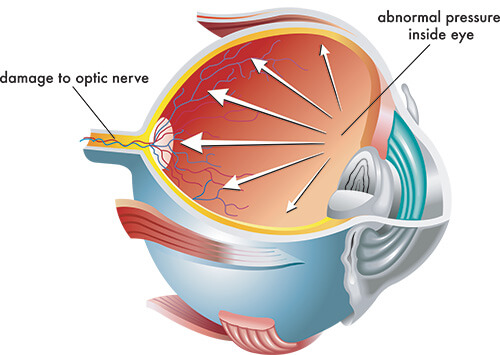 Chart Illustrating How Glaucoma Affects an Eye