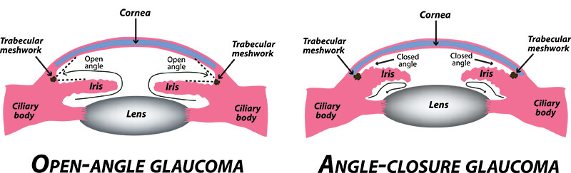 Chart Illustrating Open-Angle Glaucoma vs Angle-Closure Glaucoma