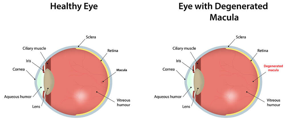 Chart Illustrating a Healthy Eye Compared to One With a Degenerated Macula